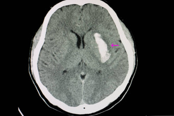 大脑内的出血