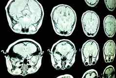 核磁共振扫描大脑