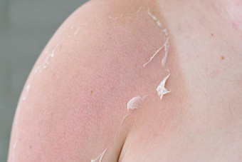 晒伤皮肤男人的身体皮肤护理保护概念