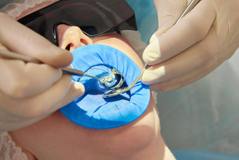 病人牙科治疗牙医办公室牙科橡胶大坝保护