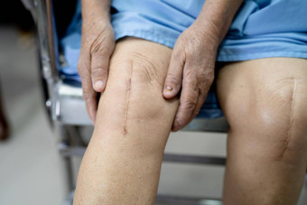亚洲高级上了年纪的夫人女人病人显示<strong>伤疤</strong>外科手术总计膝盖联合更换缝合伤口手术关节成形术床上护理医院病房健康的强大的医疗概念
