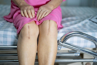 亚洲高级上了年纪的夫人女人病人显示伤疤外科手术总计膝盖联合更换缝合伤口手术关节成形术床上护理医院病房健康的强大的医疗概念
