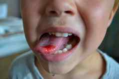 特写镜头嘴唇舌头突出血孩子的咬舌头