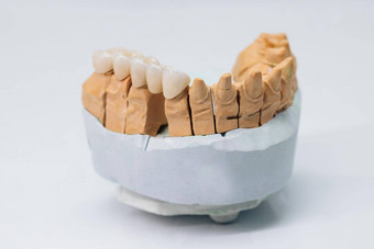 金属免费的陶瓷牙科冠石膏模型金属陶瓷牙齿桥梁