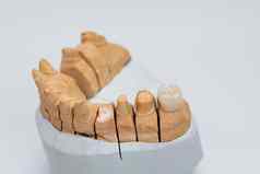 金属免费的陶瓷牙科牙齿陶瓷贴面板孤立的wite背景金属陶瓷冠石膏模型牙科实验室