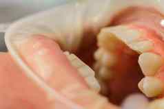 牙医抛光牙齿钻牙科过程牵开器隔离嘴唇牙龈