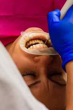 牙医的任命凶悍的人删除超声波病人牙医牵开器隔离嘴唇牙龈