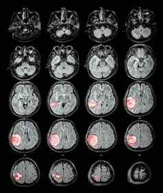 核磁共振大脑大脑肿瘤壁叶