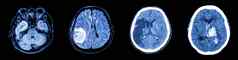 集合扫描大脑多个疾病左正常的大脑大脑肿瘤脑梗死大脑内的出血