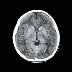 正常的扫描大脑计算断层摄影术