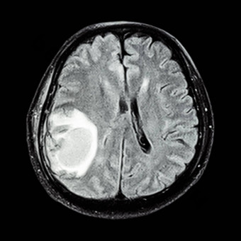 核磁共振大脑显示大脑肿瘤壁叶大脑