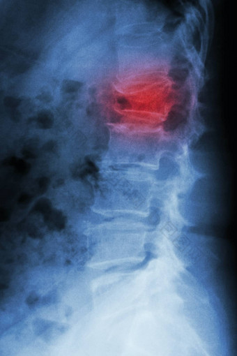 电影x射线腰椎脊柱<strong>横向</strong>显示破裂骨折腰椎