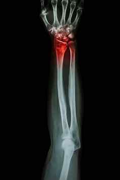 骨折远端半径手腕骨科尔斯骨折