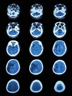 扫描计算断层摄影术大脑显示脑梗死