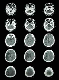 扫描计算断层摄影术大脑显示脑梗死