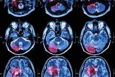 电影核磁共振磁共振成像大脑中风大脑肿瘤脑梗死大脑内的出血医疗健康护理科学背景交叉部分大脑