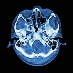 扫描大脑基地头骨骨窗口