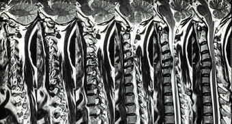 颈脊椎病阀瓣椎间盘突出核磁共振颈脊柱显示颈脊椎病阀瓣椎间盘突出压缩脊髓绳脊髓病