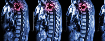 脊柱转移癌症传播胸脊柱核磁共振颈胸脊柱显示胸脊柱转移压缩脊髓绳脊髓病矢状面飞机