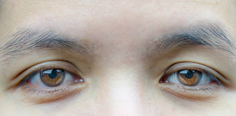 宏拍摄亚洲中间岁的女人棕色（的）眼睛皱纹眼睛显示静脉眼睛眼睑问题手术电梯