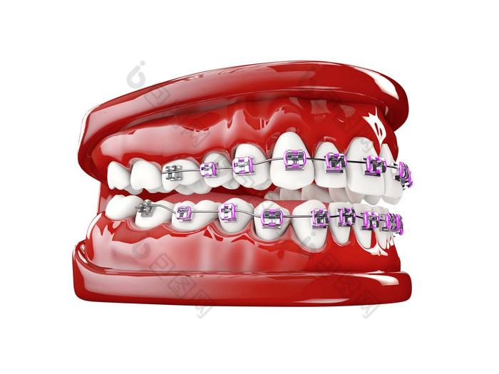 牙齿括号牙科护理概念插图清洁牙齿