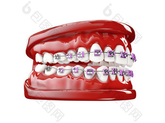 <strong>牙齿</strong>括号牙科护理概念插图