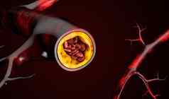 插图血细胞斑块累积胆固醇