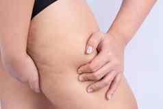 女持有推皮肤腿脂肪团橙色皮治疗处理多余的重量沉积皮下脂肪组织