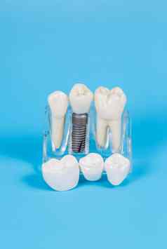 牙科冠模仿牙科假肢牙科桥植入物