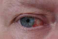 男人的眼睛宏眼睛疾病出血眼睛