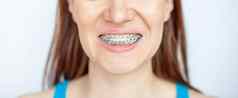 女人微笑显示白色牙齿牙套