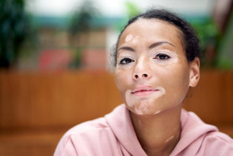 黑色的非洲美国女人白癫风色素沉着皮肤问题室内穿着粉红色的连帽衫