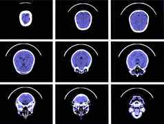 x射线图像大脑计算断层摄影术