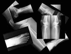 人类腿骨x射线