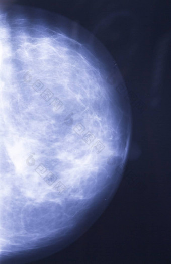 x光乳房肿瘤