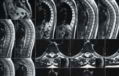 核磁共振扫描人类腰椎脊柱