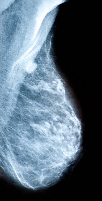 筛选乳房癌症放射学