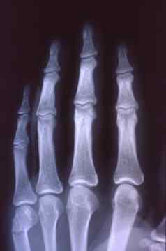 x射线图像男人。手骨头关节