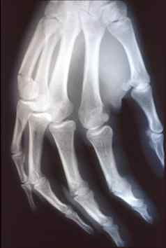 x射线图像男人。手骨头关节