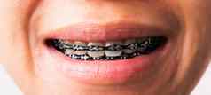女人微笑显示口白色牙齿黑色的括号支架