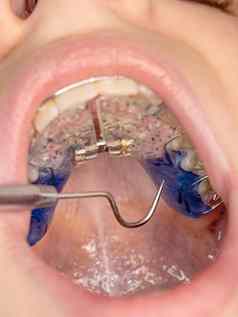 牙医检查支架牙套孩子