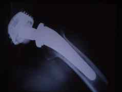 人工臀部联合人类大腿x射线图像