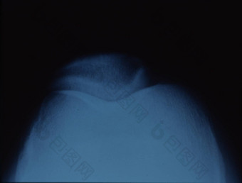 x射线图像膝盖骨联合