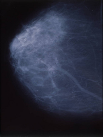 x射线乳房x光检查女乳房