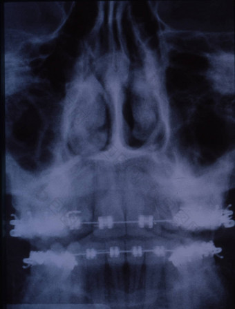 x射线图像齿列牙套牙齿