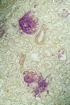 艾滋病组织真菌假丝酵母成长