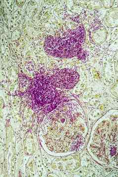 艾滋病组织真菌假丝酵母成长