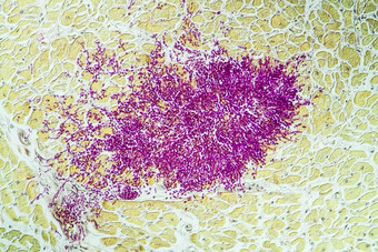 假丝酵母心肌肉<strong>艾滋</strong>病<strong>病人</strong>