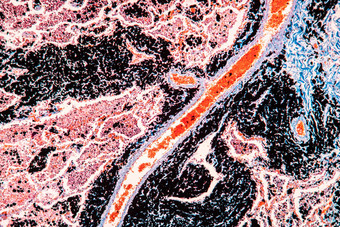 木炭灰尘肺组织显微镜