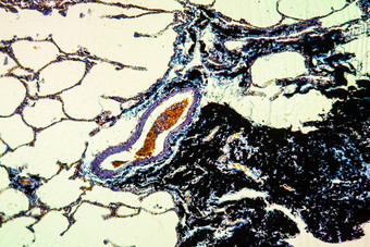 木炭灰尘肺病组织